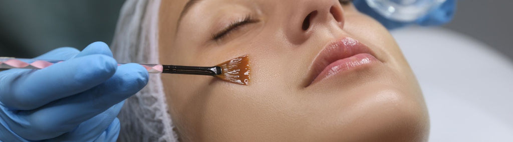 what does a chemical peel do for your skin