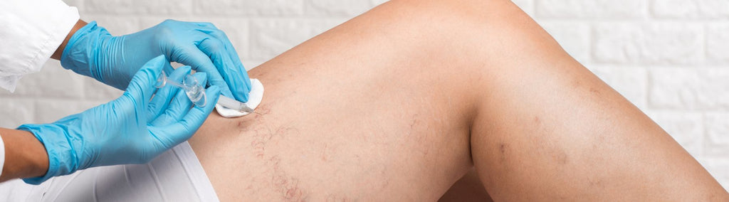 What Does Sclerotherapy Do?