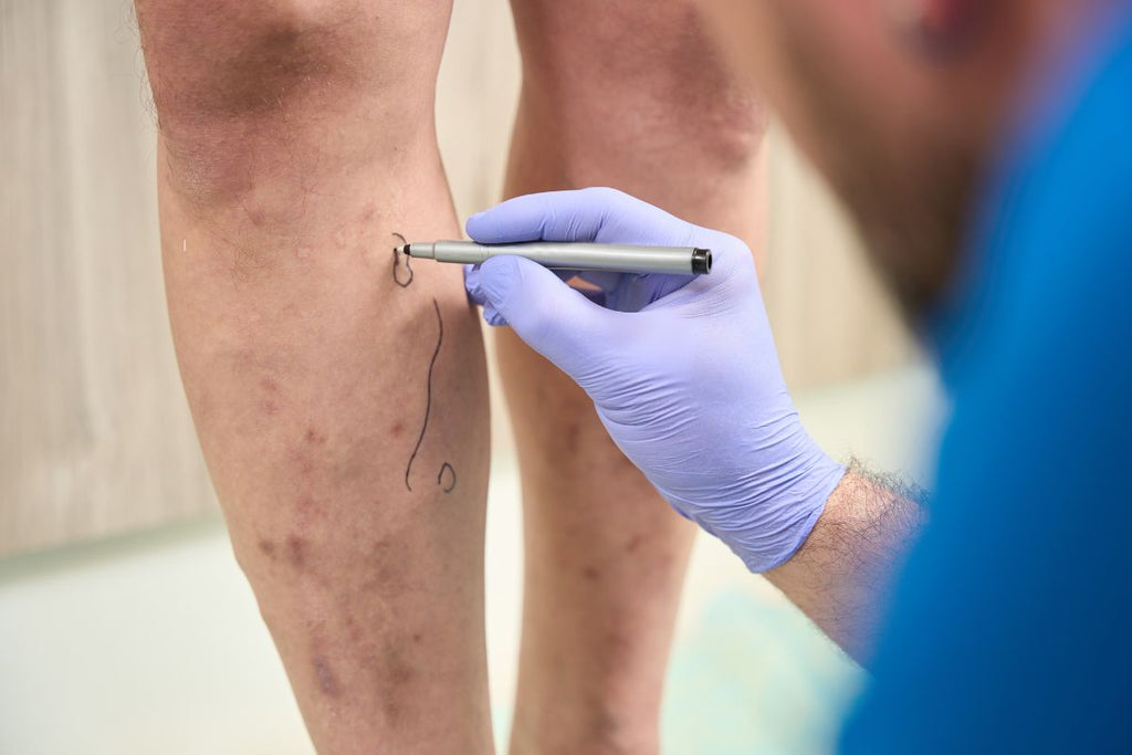 Who Can Perform Sclerotherapy in the UK?